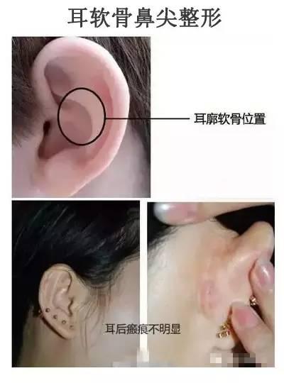 首先,取耳软骨的位置(在耳颅沟切口,即耳后,取耳甲腔的软骨)取耳软骨