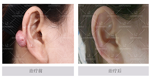 北京联合丽格疤痕中心张文辉:疤痕疙瘩不断生长怎么办？