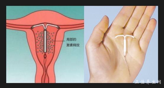 女性取环前要注意的事情