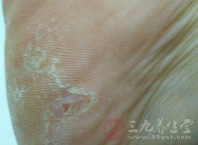 治疗脚气注意这两点