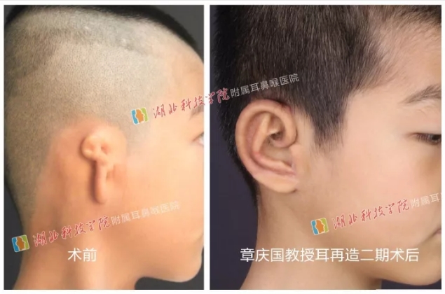 章庆国教授来院开展耳畸形修复与听力重建讲座啦