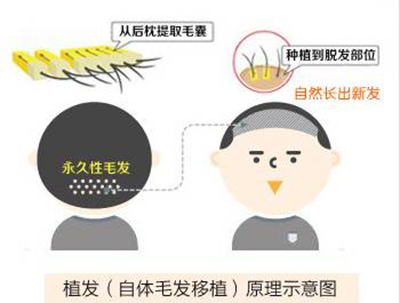 北京中德毛发移植整形医院种植的头发能维持多久